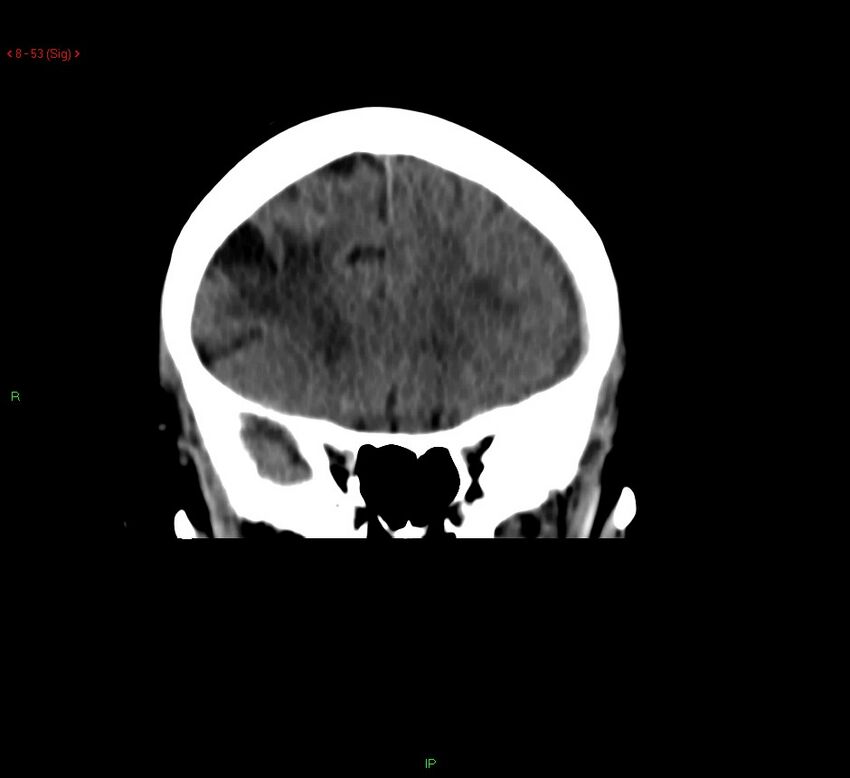 Cerebral amyloid angiopathy-associated lobar intracerebral hemorrhage (Radiopaedia 58378-65518 Coronal non-contrast 53).jpg