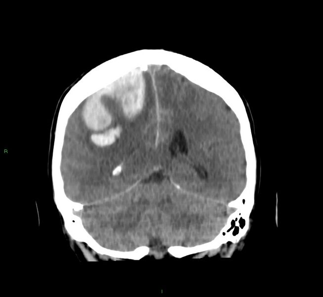 File:Cerebral amyloid angiopathy-associated lobar intracerebral hemorrhage (Radiopaedia 58756-65977 Coronal non-contrast 25).jpg