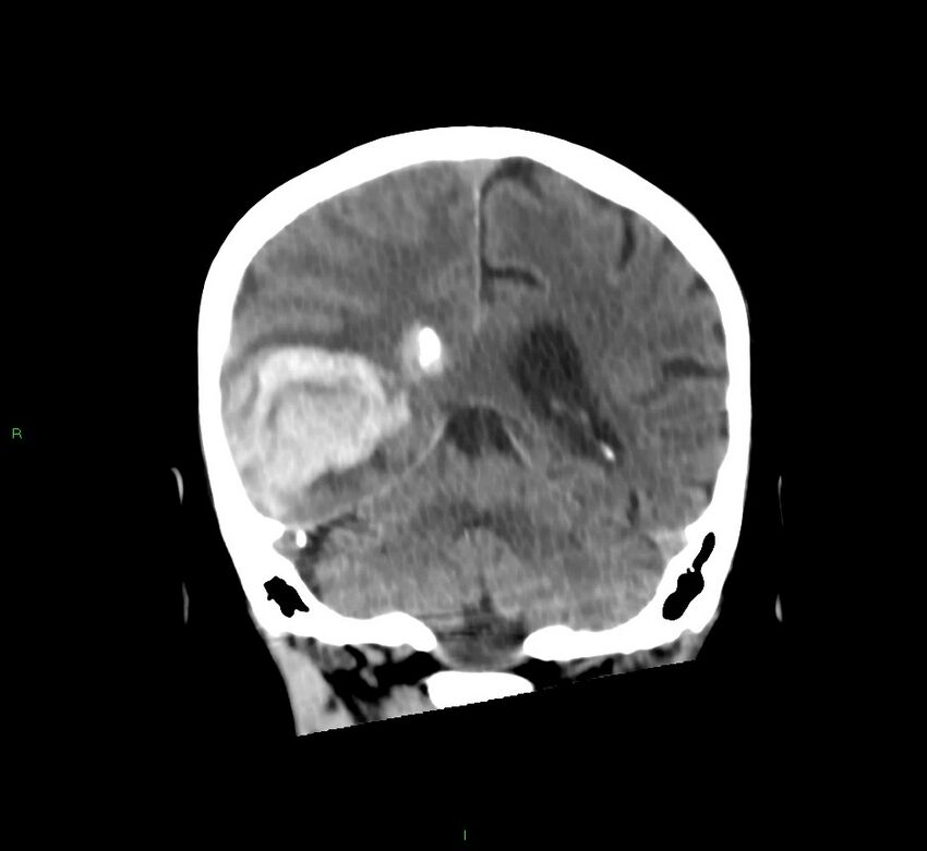 Cerebral amyloid angiopathy-associated lobar intracerebral hemorrhage (Radiopaedia 58758-65980 Coronal non-contrast 24).jpg