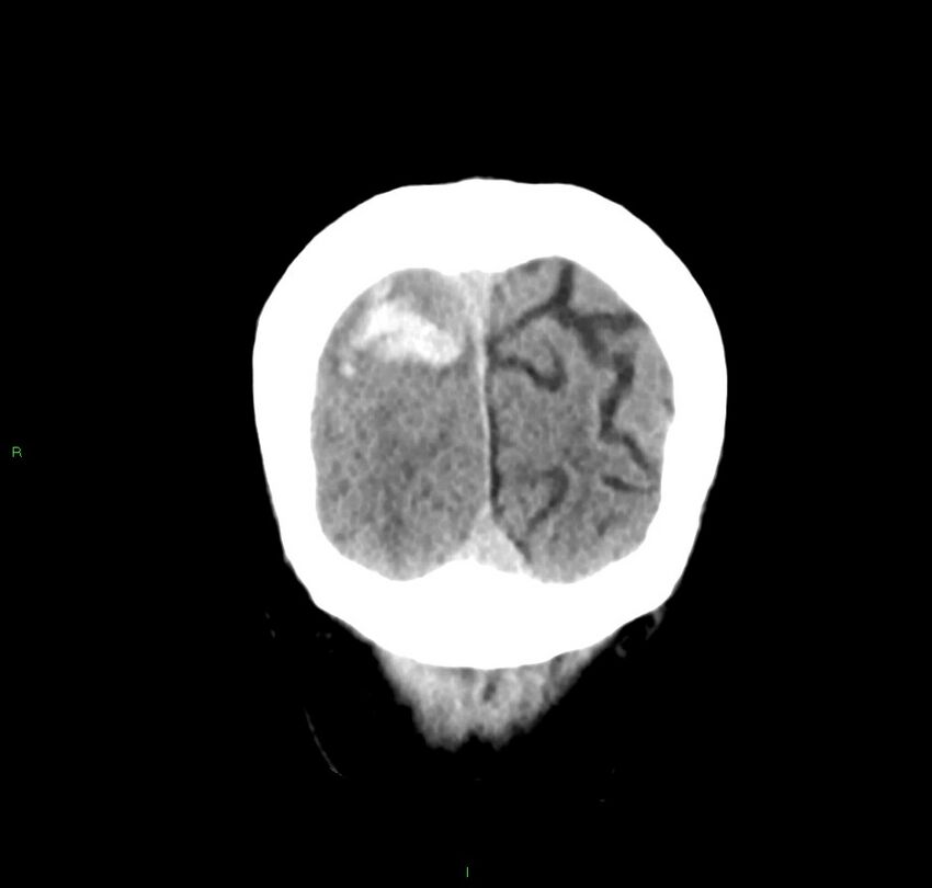 Cerebral amyloid angiopathy-associated lobar intracerebral hemorrhage (Radiopaedia 59356-66716 Coronal non-contrast 10).jpg