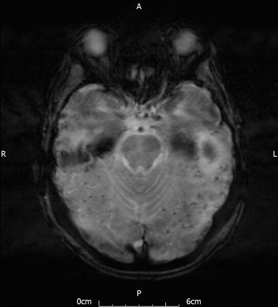 File:Cerebral amyloid angiopathy related inflammation (Radiopaedia 72772-83415 Axial SWI 9).jpg