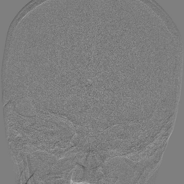 File:Cerebral aneurysm with rupture (Radiopaedia 29933-30458 LT ICA IC 8).jpg