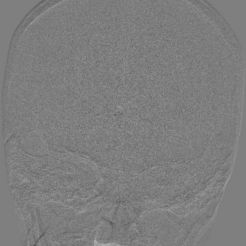 Cerebral aneurysm with rupture (Radiopaedia 29933-30458 LT ICA IC 8).jpg