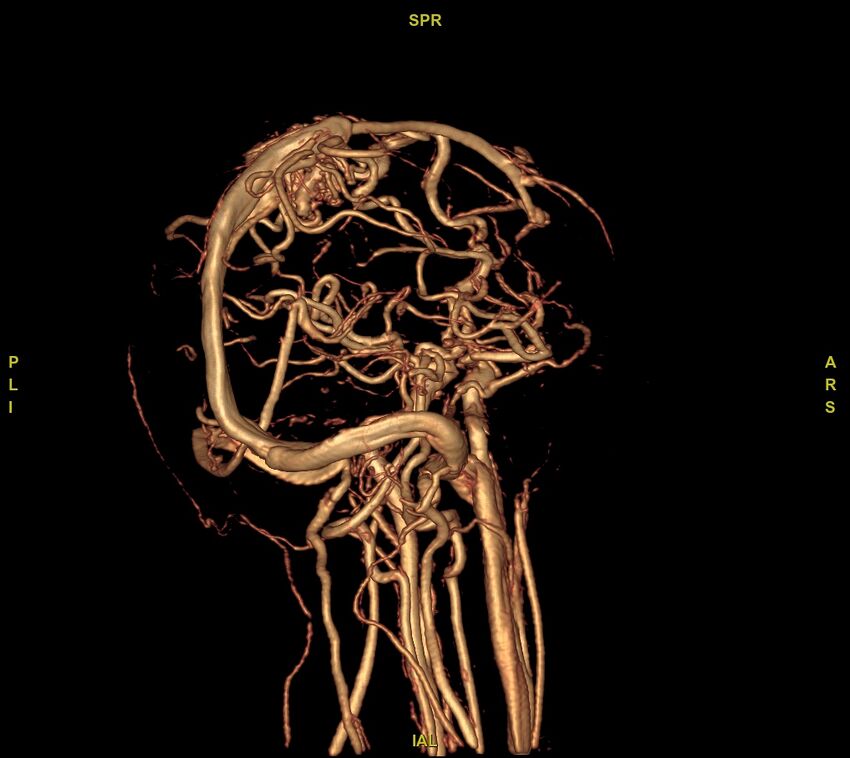 Cerebral arteriovenous malformation (Radiopaedia 61964-70029 VRT 22).jpg