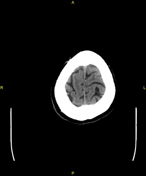 File:Cerebral autosomal dominant arteriopathy with subcortical infarcts and leukoencephalopathy (CADASIL) (Radiopaedia 86108-102051 Axial non-contrast 106).jpg