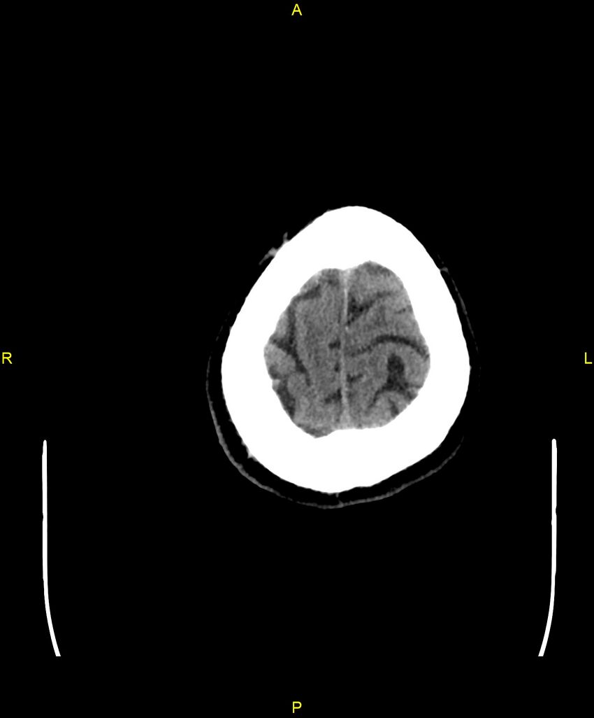 Cerebral autosomal dominant arteriopathy with subcortical infarcts and leukoencephalopathy (CADASIL) (Radiopaedia 86108-102051 Axial non-contrast 106).jpg