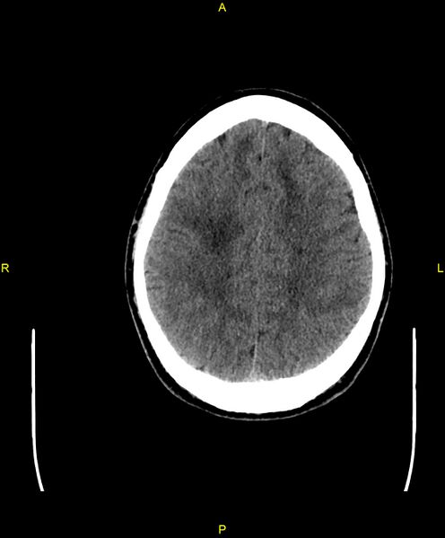 File:Cerebral autosomal dominant arteriopathy with subcortical infarcts and leukoencephalopathy (CADASIL) (Radiopaedia 86108-102051 Axial non-contrast 80).jpg