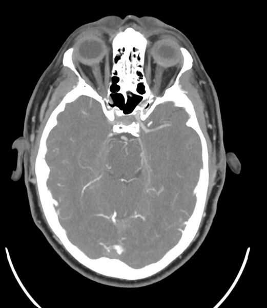 File:Cerebral dural venous sinus thrombosis (Radiopaedia 86514-102576 A 45).jpg