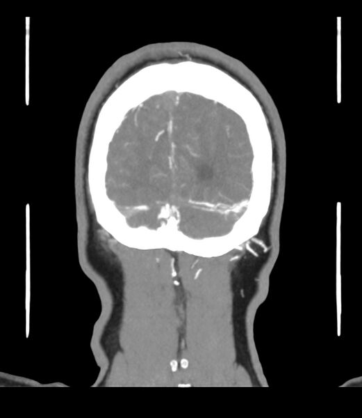 File:Cerebral dural venous sinus thrombosis (Radiopaedia 86514-102576 B 69).jpg