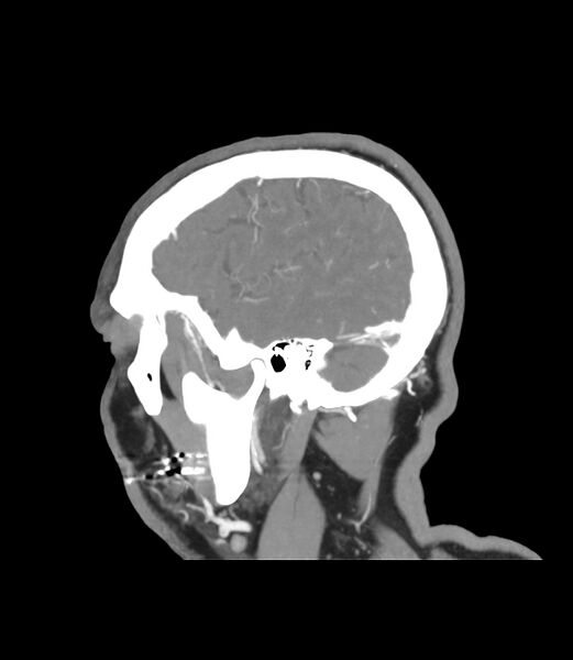 File:Cerebral dural venous sinus thrombosis (Radiopaedia 86514-102576 C 50).jpg