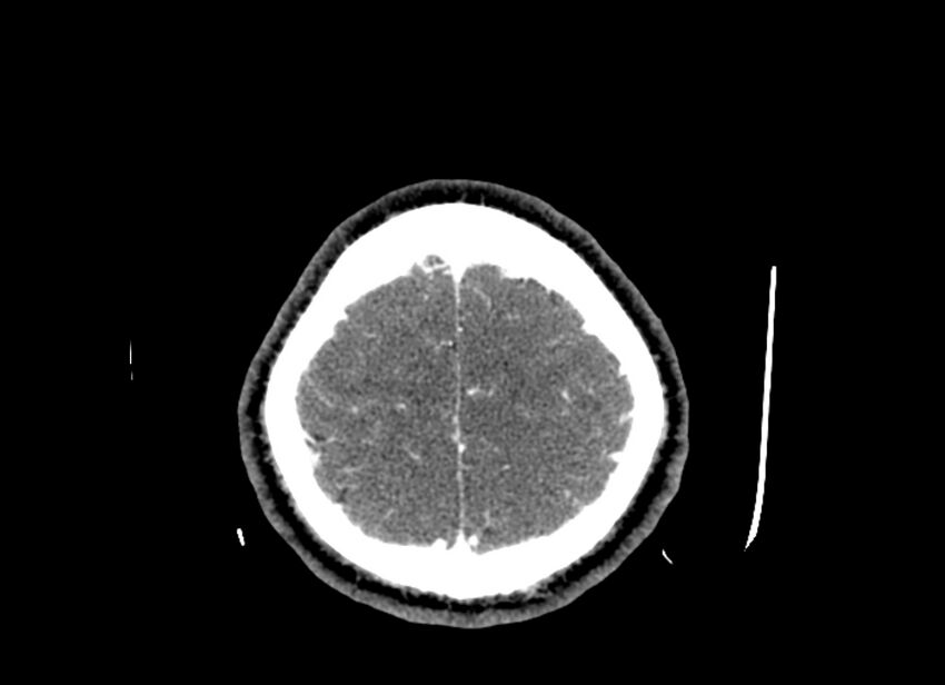 Cerebral edema (Radiopaedia 82519-96661 B 12).jpg