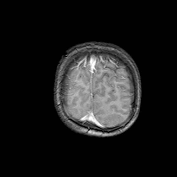 File:Cerebral tuberculoma (Radiopaedia 41152-43932 Coronal T1 C+ 21).jpg