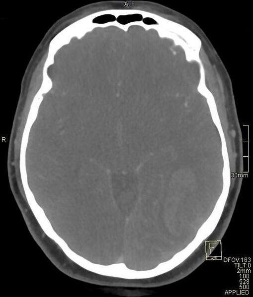 File:Cerebral venous sinus thrombosis (Radiopaedia 91329-108965 Axial venogram 38).jpg