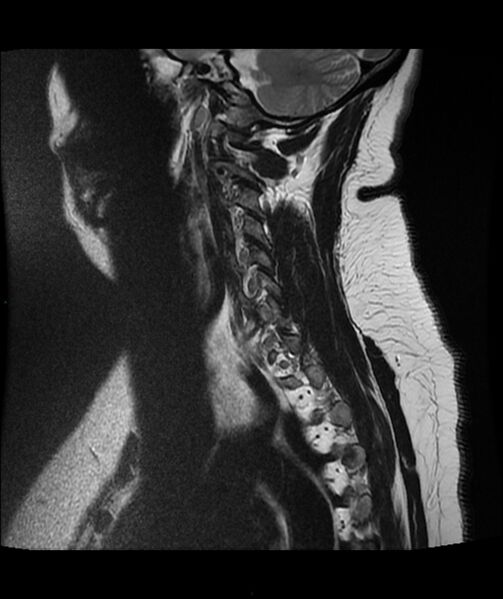 File:Cervical disc prolapse (Radiopaedia 80258-93598 Sagittal T2 14).jpg