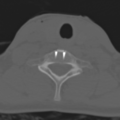 Cervical disc replacement (Radiopaedia 37383-39205 Sagittal bone window 1).png