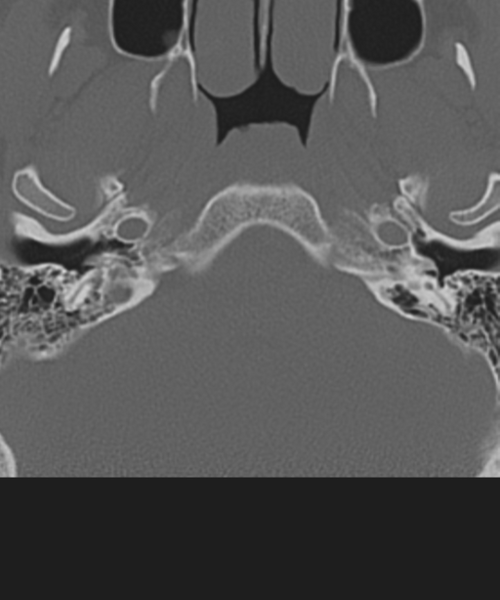 File:Cervical intercalary bone (Radiopaedia 35211-36748 Axial bone window 3).png