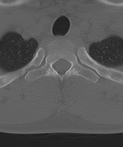 File:Cervical intercalary bone (Radiopaedia 35211-36748 Axial bone window 63).png