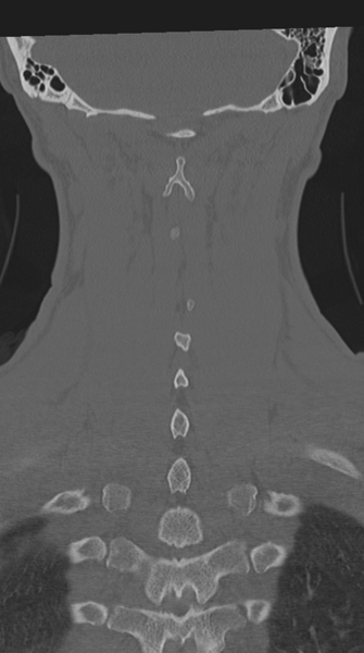 File:Cervical intercalary bone (Radiopaedia 35211-36748 Coronal bone window 61).png