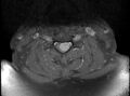 Cervical schwannoma (Radiopaedia 72399-82934 Axial T1 C+ fat sat 11).jpg