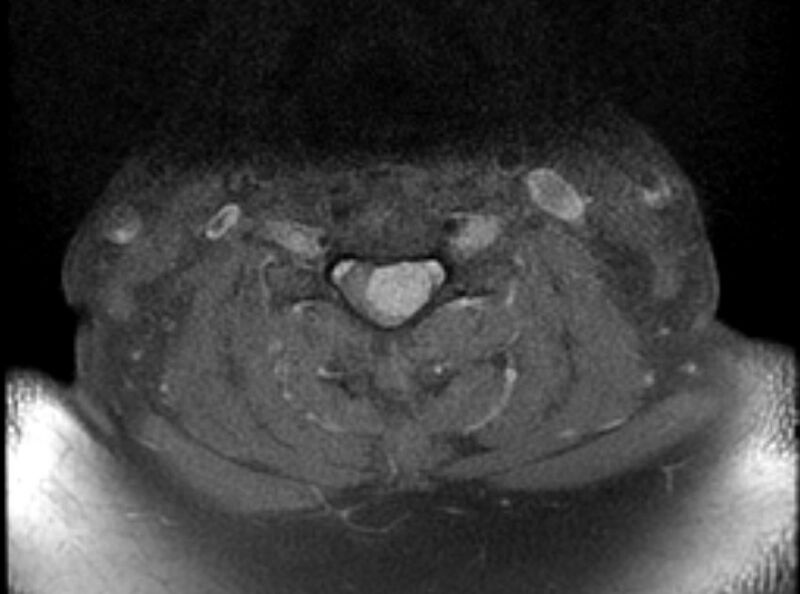 File:Cervical schwannoma (Radiopaedia 72399-82934 Axial T1 C+ fat sat 11).jpg