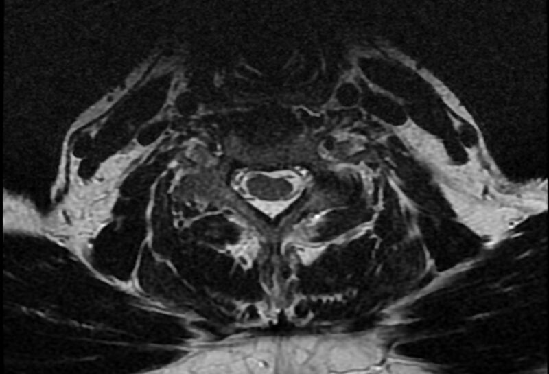 File:Cervical schwannoma (Radiopaedia 72399-82934 Axial T2 16).jpg