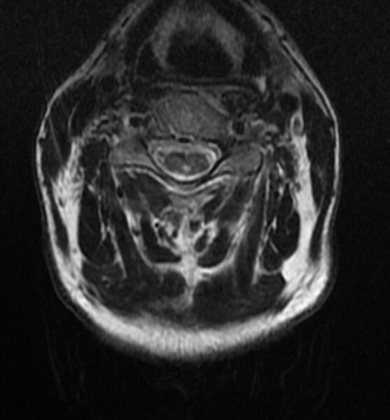 File:Cervical spondylodiscitis (Radiopaedia 81362-95110 Axial T2 7).jpg