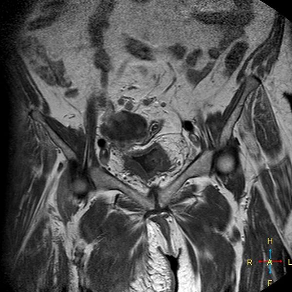 File:Cervical stump squamous cell carcinoma (Radiopaedia 48049-52858 Coronal T1 C+ 2).jpg