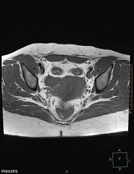 File:Cesarian scar endometriosis (Radiopaedia 68495-78066 Axial T1 14).jpg
