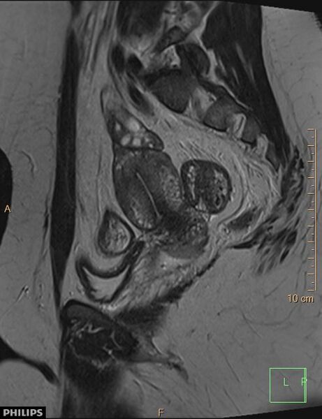 File:Cesarian scar endometriosis (Radiopaedia 68495-78066 Sagittal T2 18).jpg
