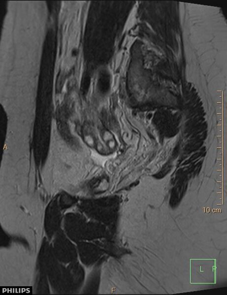 File:Cesarian scar endometriosis (Radiopaedia 68495-78066 Sagittal T2 6).jpg