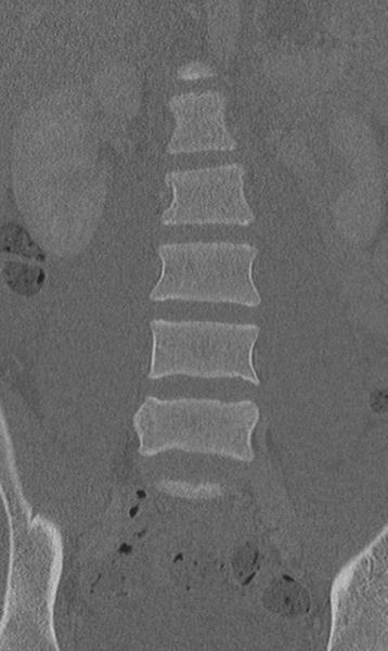 File:Chance fracture (Radiopaedia 40360-42912 Coronal bone window 23).png