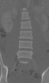 Chance fracture (Radiopaedia 40360-42912 Coronal bone window 23).png