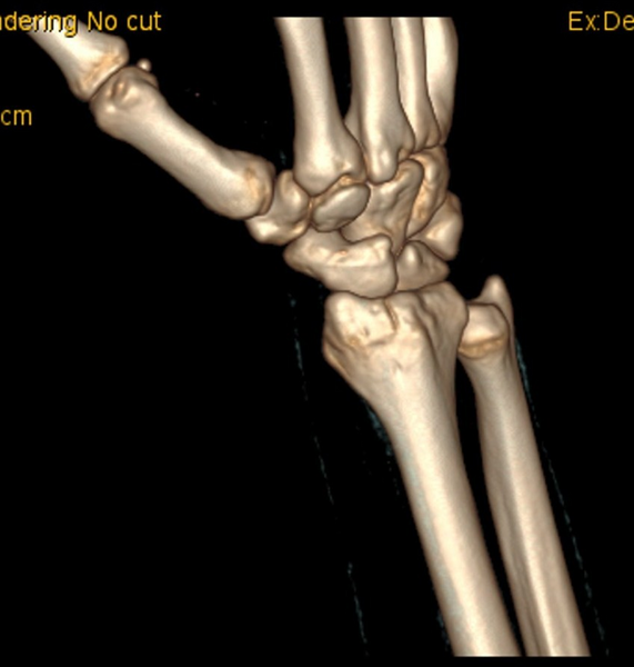 File:Chauffeur's (Hutchinson) fracture (Radiopaedia 58043-65079 3D volume rendered images 3).png