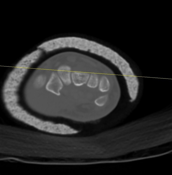 File:Chauffeur's (Hutchinson) fracture (Radiopaedia 58043-65079 Axial 13).png