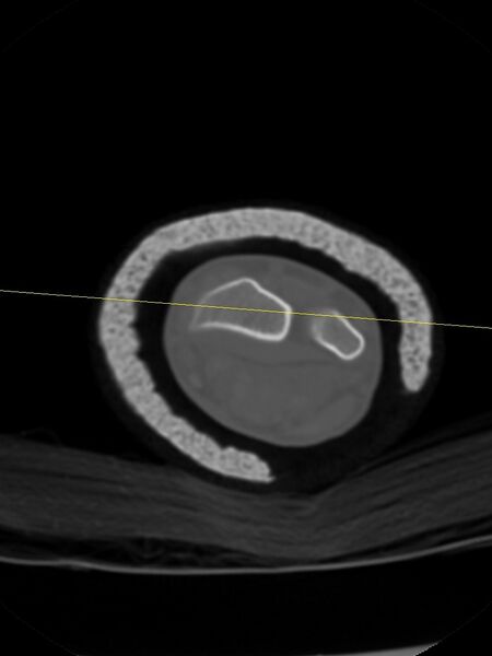 File:Chauffeur's (Hutchinson) fracture (Radiopaedia 58043-65079 Axial bone window 23).jpg