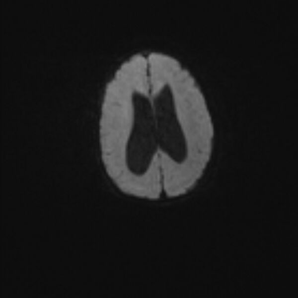 File:Chiari III malformation with occipital encephalocele (Radiopaedia 79446-92559 Axial DWI 35).jpg