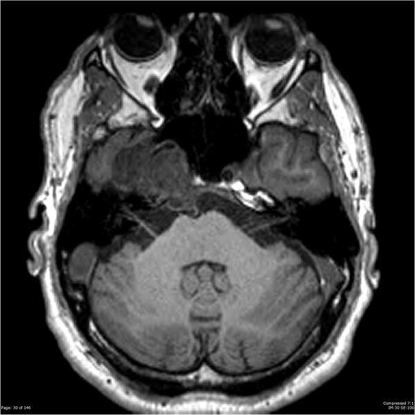 File:Chondrosarcoma of skull base- grade II (Radiopaedia 40948-43654 Axial T1 30).jpg