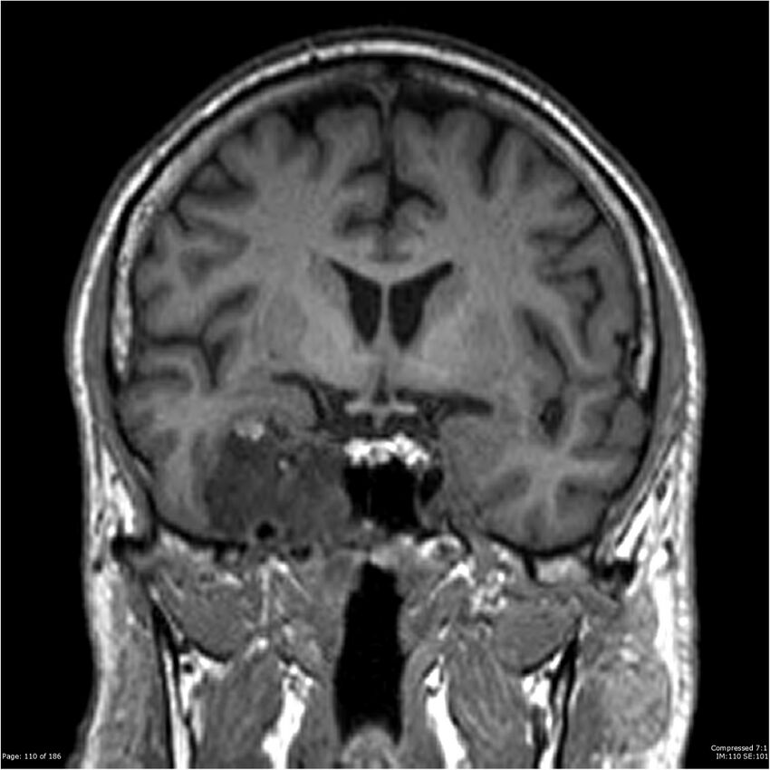 Chondrosarcoma of skull base- grade II (Radiopaedia 40948-43654 Coronal T1 31).jpg