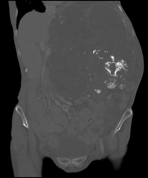 File:Chondrosarcoma of the spine (Radiopaedia 49871-55143 Coronal bone window 25).jpg