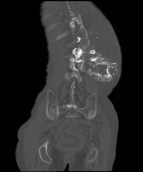 File:Chondrosarcoma of the spine (Radiopaedia 49871-55143 Coronal bone window 6).jpg