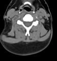 Chordoma (C4 vertebra) (Radiopaedia 47561-52188 Axial non-contrast 30).png