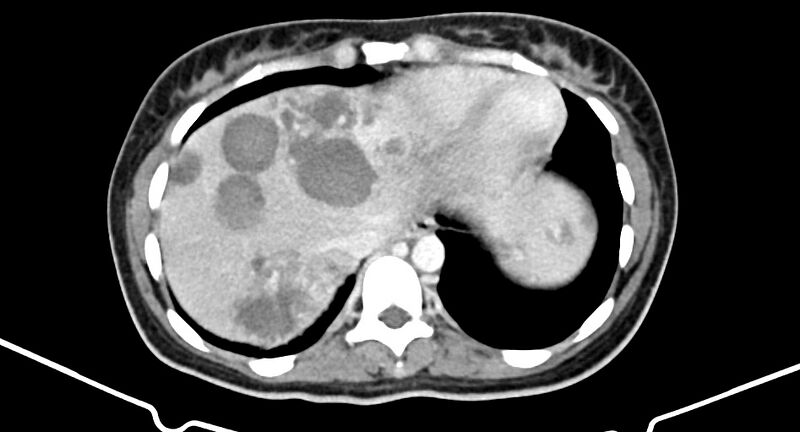 File:Choriocarcinoma liver metastases (Radiopaedia 74768-85766 A 29).jpg