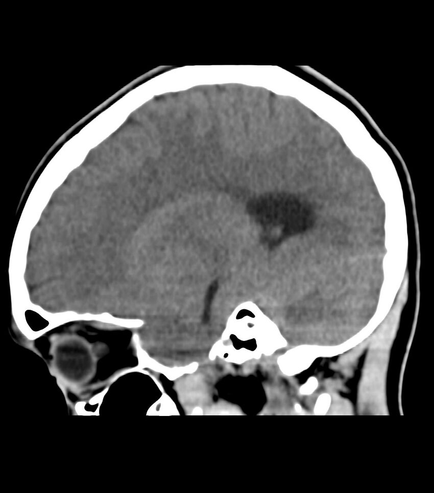 Choroid plexus carcinoma (Radiopaedia 91013-108552 B 25).jpg