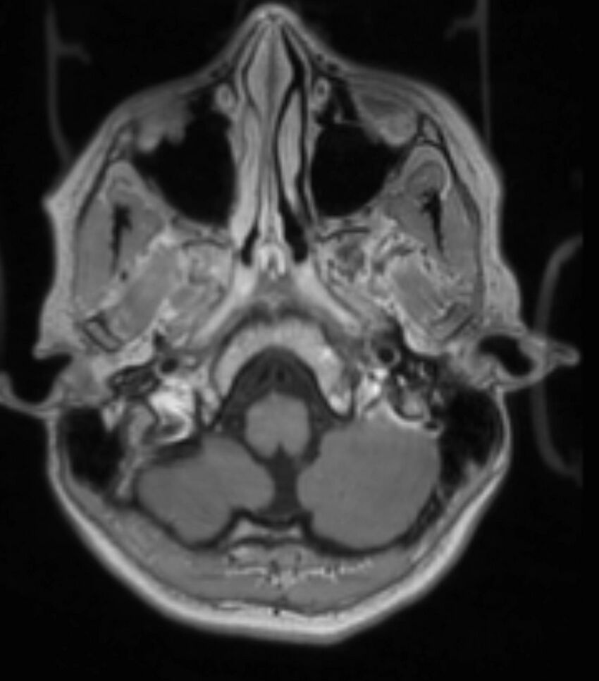 Choroid plexus carcinoma (Radiopaedia 91013-108553 Axial T1 C+ 83).jpg