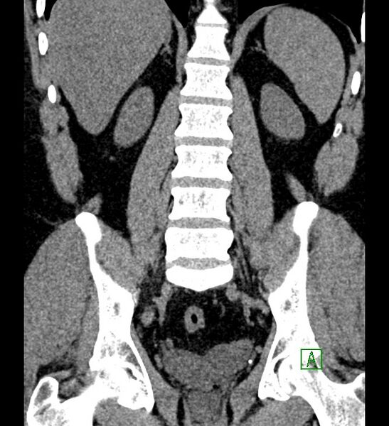 File:Chromophobe renal cell carcinoma (Radiopaedia 84286-99573 Coronal non-contrast 121).jpg