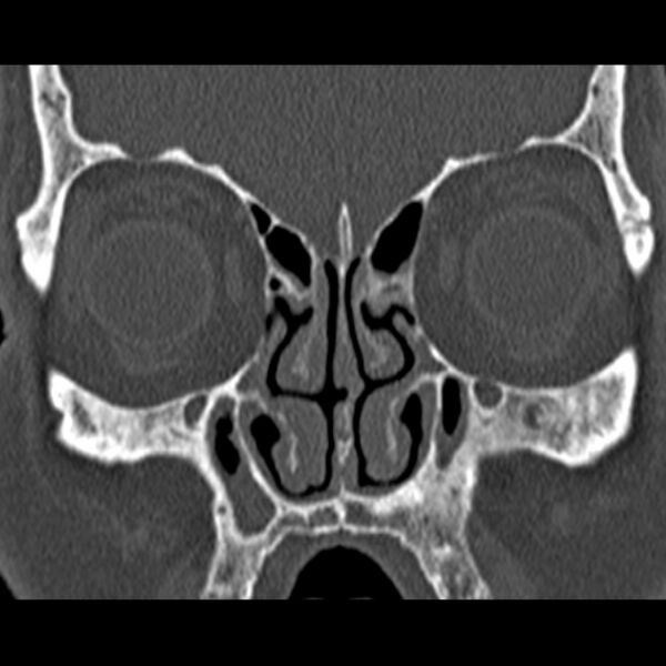 File:Chronic maxillary sinusitis (Radiopaedia 27879-28116 Coronal bone window 19).jpg