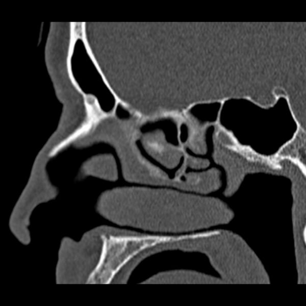 File:Chronic maxillary sinusitis (Radiopaedia 27879-28116 Sagittal bone window 24).jpg