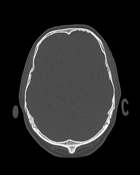 File:Chronic maxillary sinusitis caused by a foreign body (Radiopaedia 58521-65676 Axial bone window 331).jpg