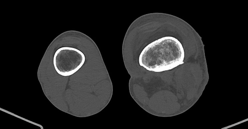 Chronic osteomyelitis (with sequestrum) (Radiopaedia 74813-85822 Axial non-contrast 162).jpg
