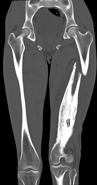 File:Chronic osteomyelitis (with sequestrum) (Radiopaedia 74813-85822 Coronal non-contrast 31).jpg
